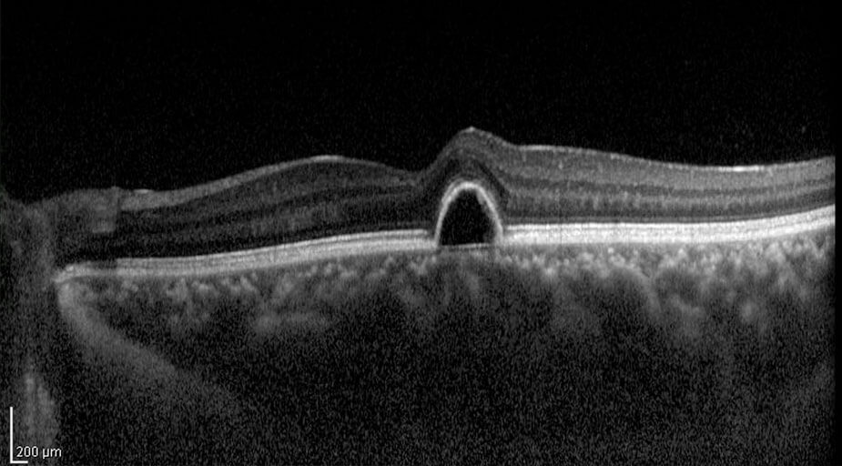 Augenärzte Sindelfingen – Augenheilkunde – OCT – Optische Kohärenz Tomographie